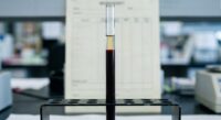 Probówka z krwią w stojaku laboratoryjnym do oznaczenia odczynu Biernackiego, w tle blat z dokumentacją wyników.